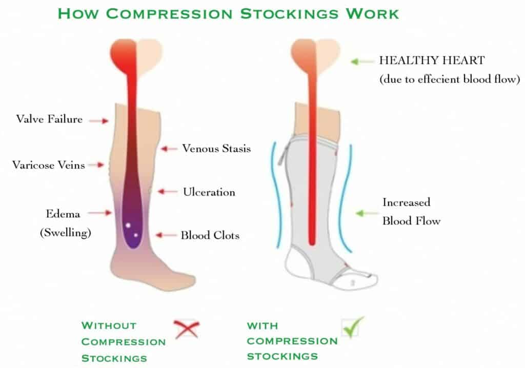 Compression stockings push blood from the bottom up