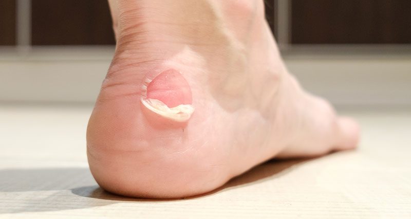 Why am I suddenly getting blisters when running?