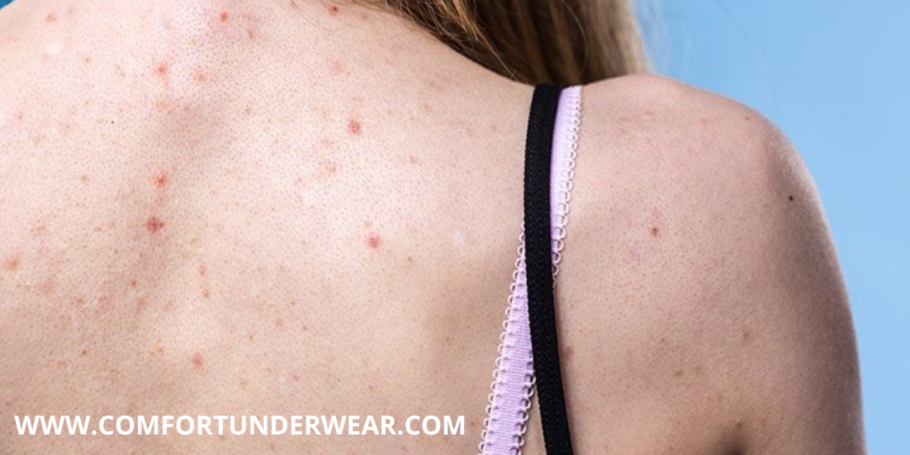 What materials are bad for acne?