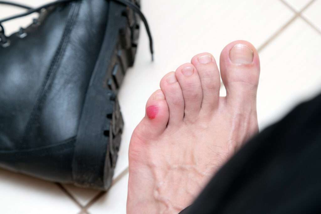 Do hiking socks prevent blisters?